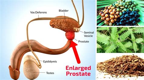 Herbs for Prostate - Herbal Remedies