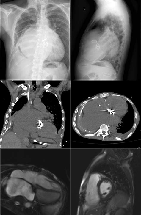 Cardiac and Vascular Calcification | Plastic Surgery Key