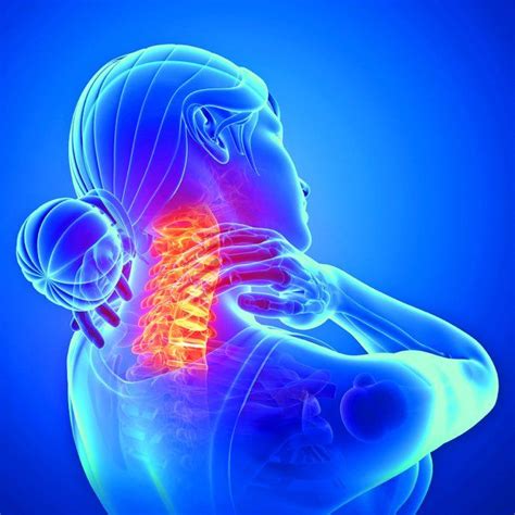 Neck Arthritis Is Common - Arthritis Advisor