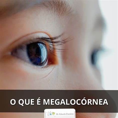 O que é megalocórnea? | Dr. Eduardo Pantaleão