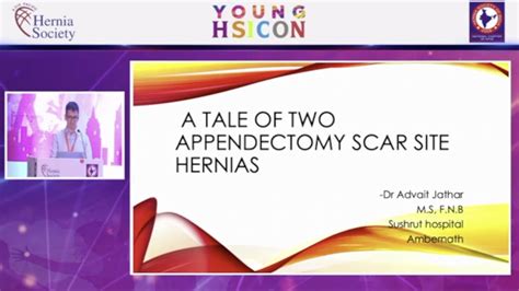 Two appendicectomy scar site hernias - YouTube