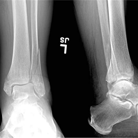 This same patient presenting 10 days later. X-rays now reveal ...