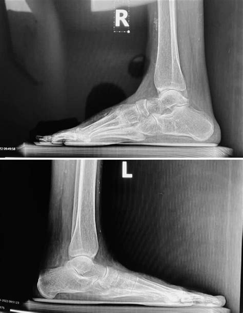 Cavovarus deformity of one foot with planovalgus deformity of the contralateral foot (Wind-swept ...