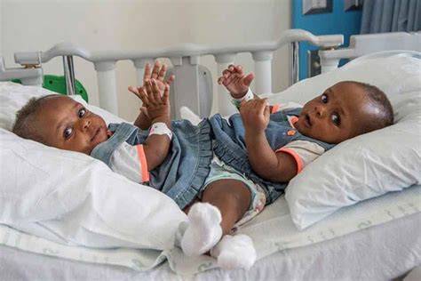 Conjoined Twins, Miracle and Testimony Undergo 18-hour Successful Surgery Operation at US Hospital