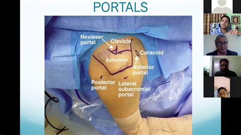 DIAGNOSTIC SHOULDER ARTHROSCOPY & DECISION MAKING IN SLAP TEAR - YouTube