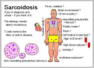 sarcoidosis Lofgren’s syndrome