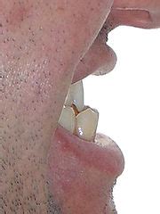 Category:Maxillary hypoplasia - Wikimedia Commons