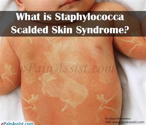 What is Staphylococcal Scalded Skin Syndrome|Causes|Symptoms|Treatment ...