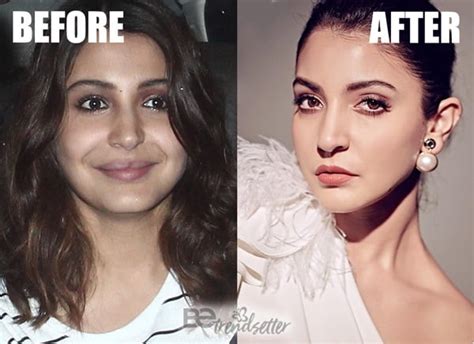 Anushka Sharma Plastic Surgery Disaster Controversy Exposed