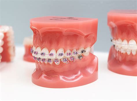 Braces Colours: Choosing The Right One « Smile Team Orthodontics | Blog