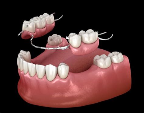 What Is the Difference Between Partial Dentures and Dental Bridges?