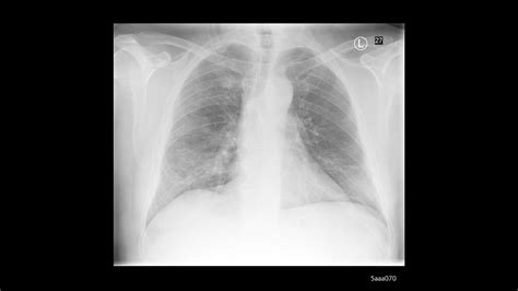 X-ray imaging for COVID-19 patients