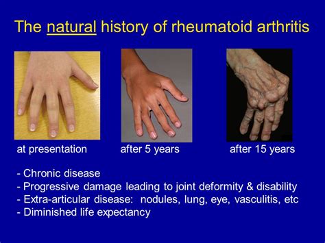 Rheumatoid Arthritis Treatment