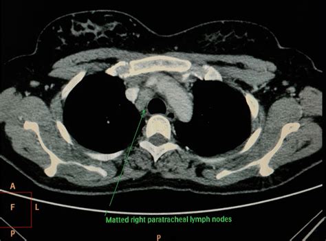 Computed tomography scan of the chest showing mediastinal lymphadenopathy | Download Scientific ...