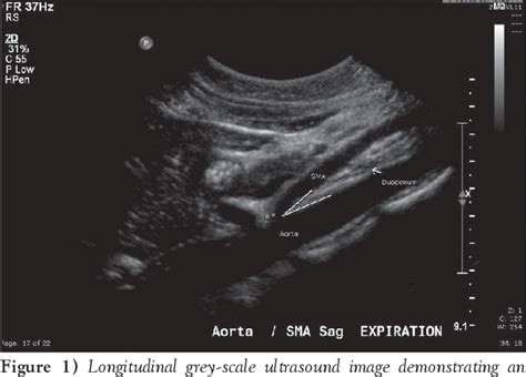 Inferior Mesenteric Artery Ultrasound