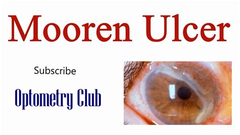 Mooren's Ulcer Introduction, Clinical Features and Treatment - YouTube