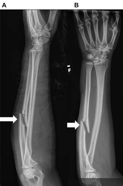 Ulnar fractures on x-ray may be indicator of domestic violence