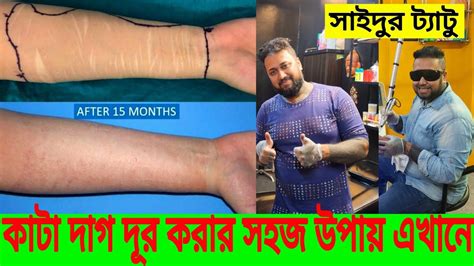 কাটা দাগ দূর করার সহজ উপায় | ব্লেডে কাটা দাগ দূর করার লেজার ট্রিটম্যান্ট | How To Remove Cut ...