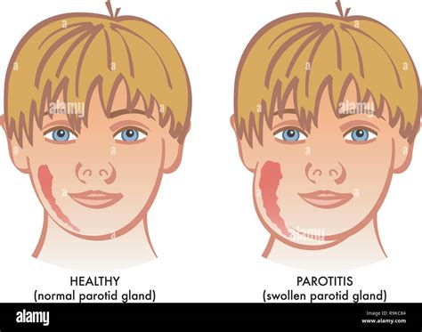 Swollen Glands