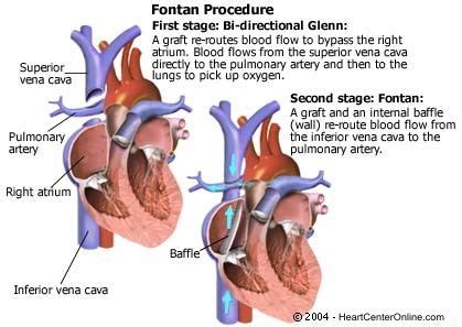 Fontan Operation | Pediatric heart, Heart surgery, Congenital heart defect