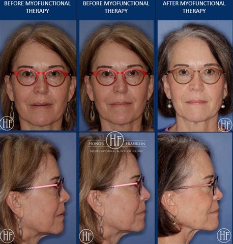 Formal Orofacial Myofunctional Therapy Gallery