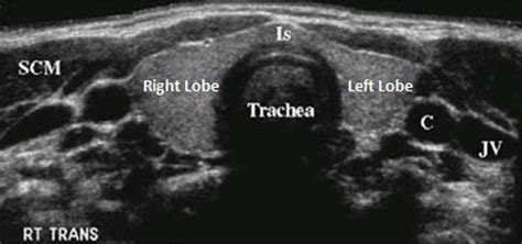 Pin by Ysabel on ultrasound images in 2020 | Thyroid ultrasound ...