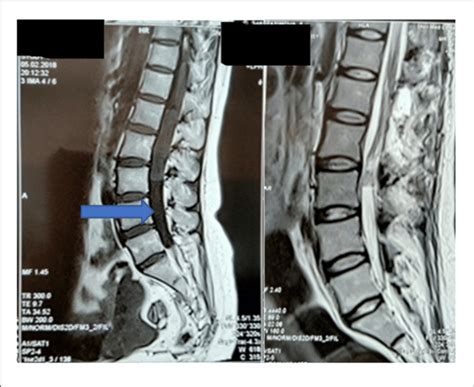 | MRI of the cervical spine, preoperative and 2 days post-surgery. A... | Download Scientific ...