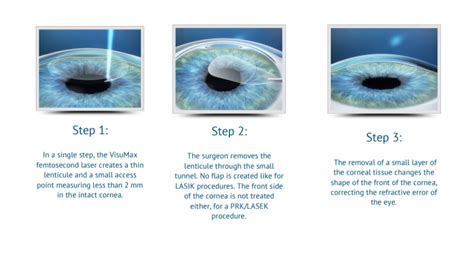 Lasik / Femto Lasic procedure advantages and disadvantages & it's More