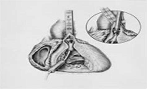 Pulmonary atresia