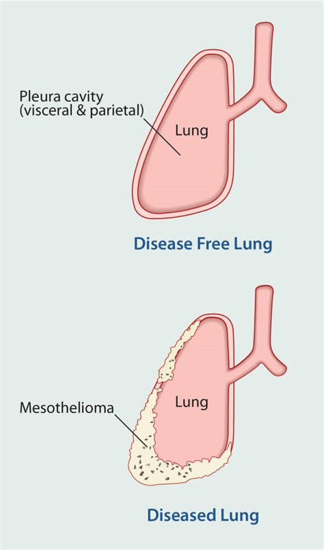 Mesothelioma Symptoms | Comprehensive Cancer Information & Facts