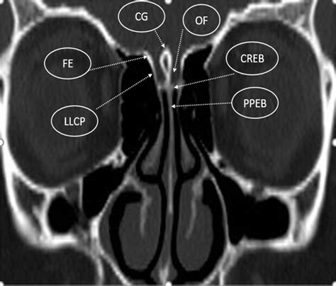 Coronal CT image showing; The different anatomical structures of the... | Download Scientific ...