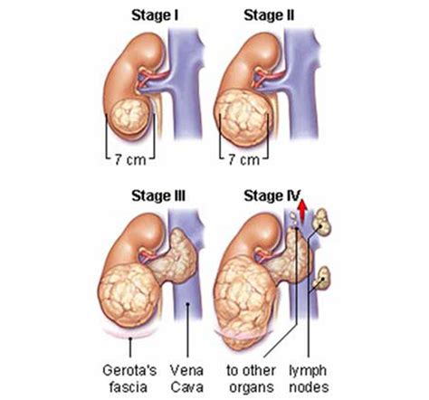 Wilms Tumor - Physiopedia