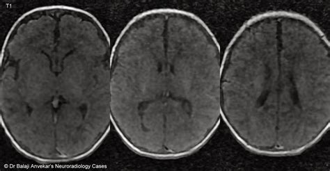 Dr Balaji Anvekar FRCR: Germinal matrix hemorrhage MRI Brain