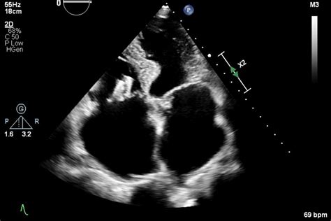 Patient Information - Cardiology Care | A / Prof Lisa Simmons