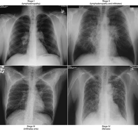 Sarcoidosis Effects On The Lung Tissue As Seen On Radiographs With Several X-Ray Representations ...