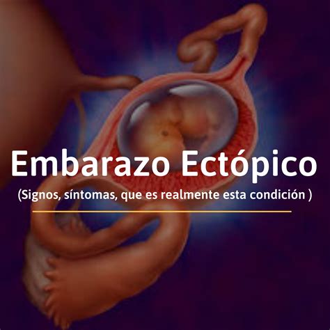 Embarazo Ectópico, es el resultado de un defecto en la fisiología reproductiva que permite que ...