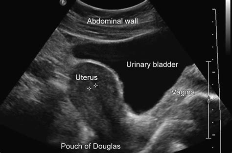 Bladder Uterus Anatomy