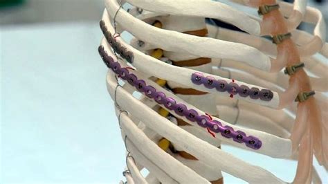 New 'rib plating' procedure helps patients of broken ribs | KSL.com