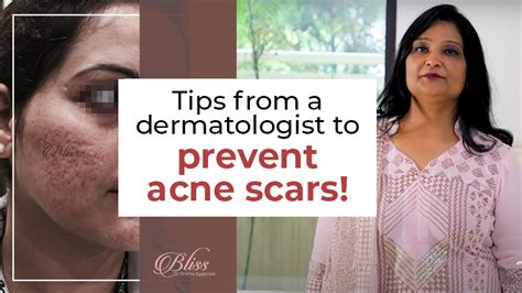 Tips from a Dermatologist to Prevent Acne Scars!