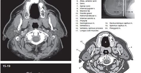 Ct Scan Soft Tissue Neck With Contrast - mapageprek