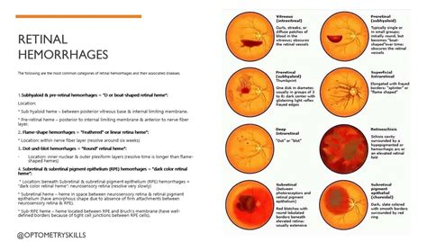 Types of Retinal Hemorrhages and its treatment. - An Eye Care Blog