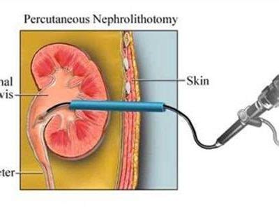 Percutaneous Nephrostomy and DJ stenting - Dr. Yadav Munde