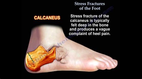 Stress Fractures Of The Foot - Everything You Need To Know - Dr. Nabil Ebraheim - YouTube