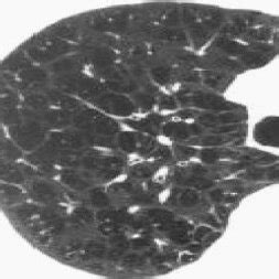 Axial HRCT image in patient with centriacinar emphysema in the right ...