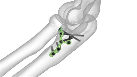 Coronoid Plate | Acumed