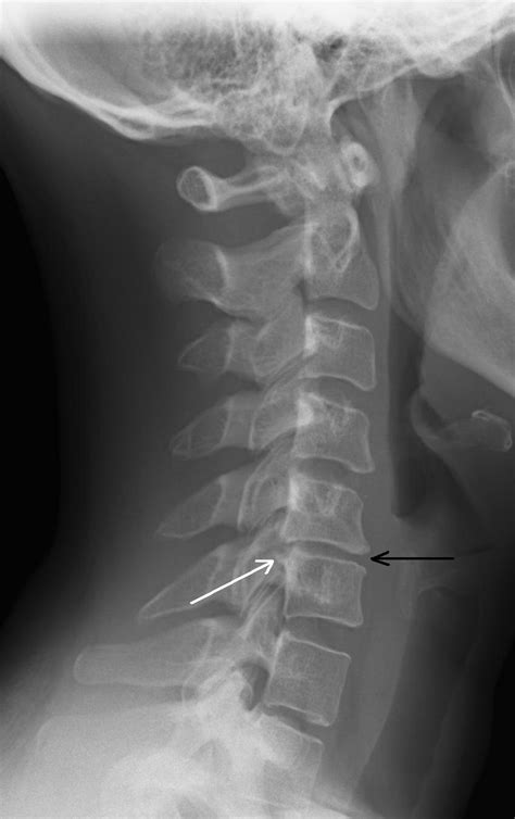 Degenerative Disc: Osteoarthritis And Degenerative Disc Disease