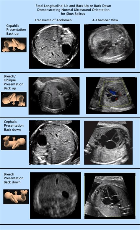 types of fetal presentation ultrasound