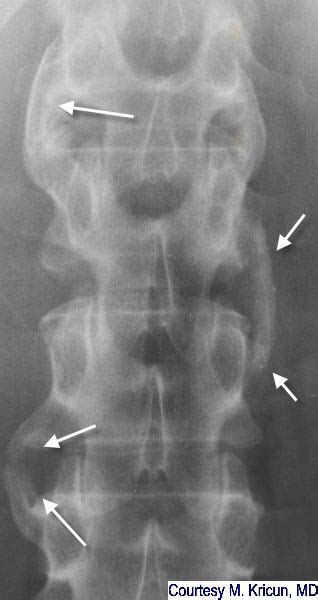 LearningRadiology - Psoriatic Arthritis, Spondylitis