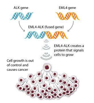 About ALK-positive Lung Cancer | Navigating ALK