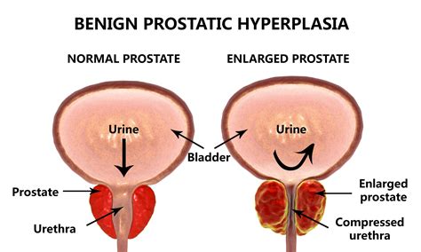 what is the best treatment for enlarged prostate gland